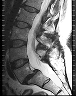 mri-spondylolisthesis