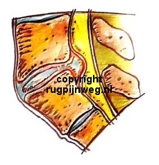 hernia