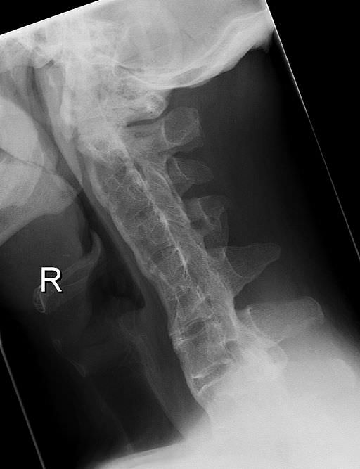 Ziekte van Bechterew Rugpijnweg.nl
