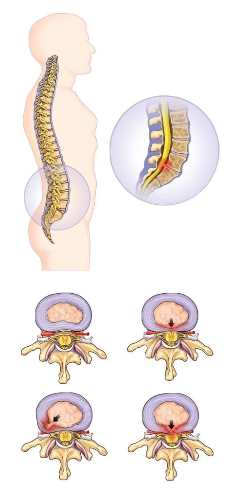 Hernia Tussenwervelschijven