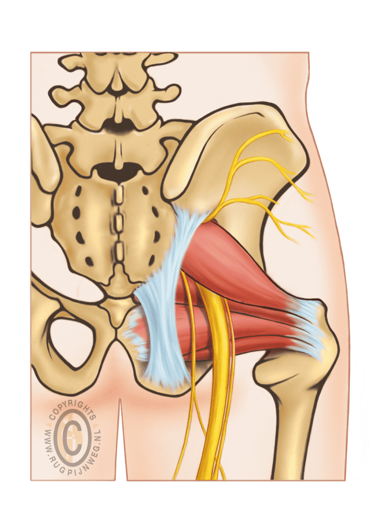 Piriformis Syndroom En Ischias