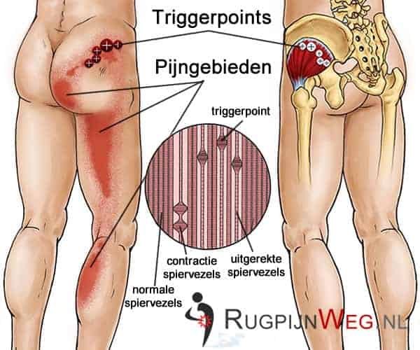 Wat Is Een Triggerpoint